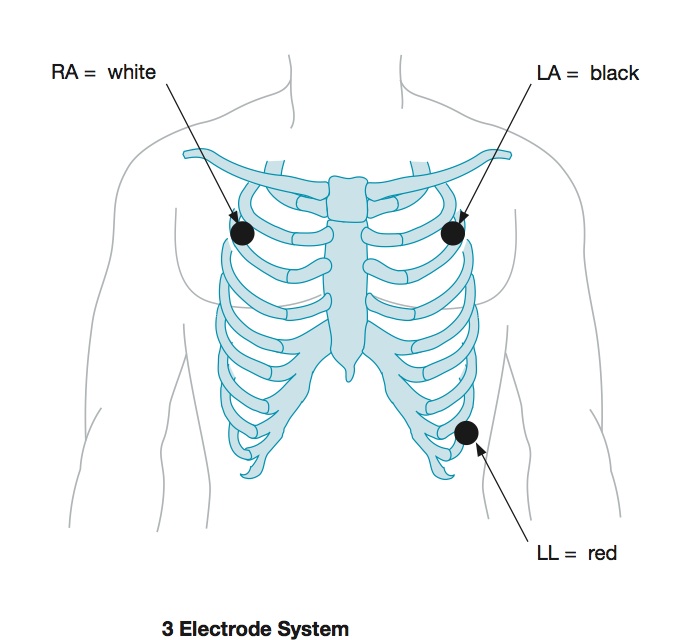 Three electrode ECG placement on the torso
